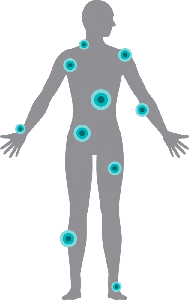StimRouter PNS Targets Pain in Diverse Locations